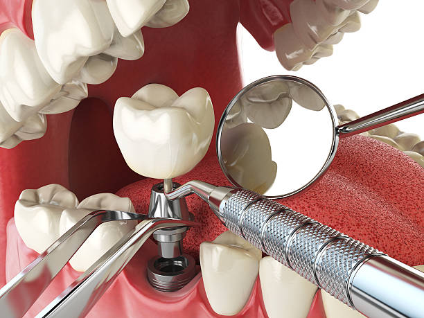 Best Emergency Root Canal Treatment in Dalton Gardens, ID